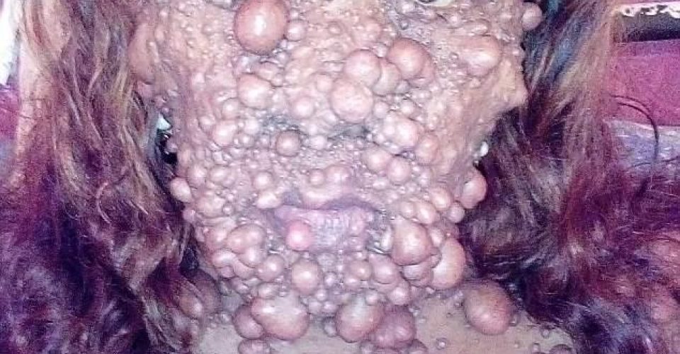 عجیب‌ترین بیماری پوستی در دنیا چیست + تصاویر